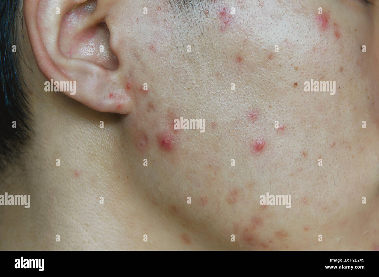 Close-up of acne and pimple on the skin, Acne on the face caused by Hormone, The scars and wrinkle and acne inflammation on the face skin. Stock Photo