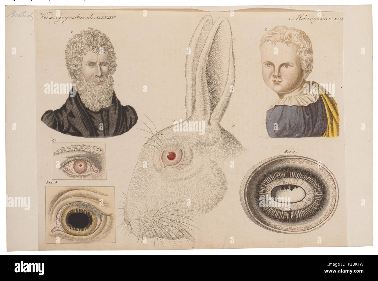 Homo sapiens - Albino . between 1700 and 1880 UBA01 IZ19600157-y