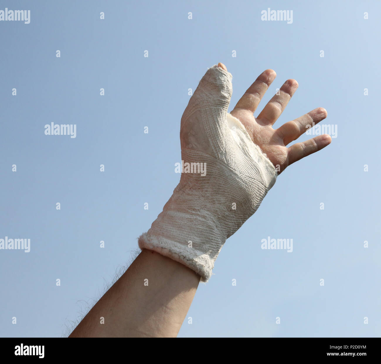 man with a cast hand due to a domestic accident that tends his limb to the  sky Stock Photo - Alamy