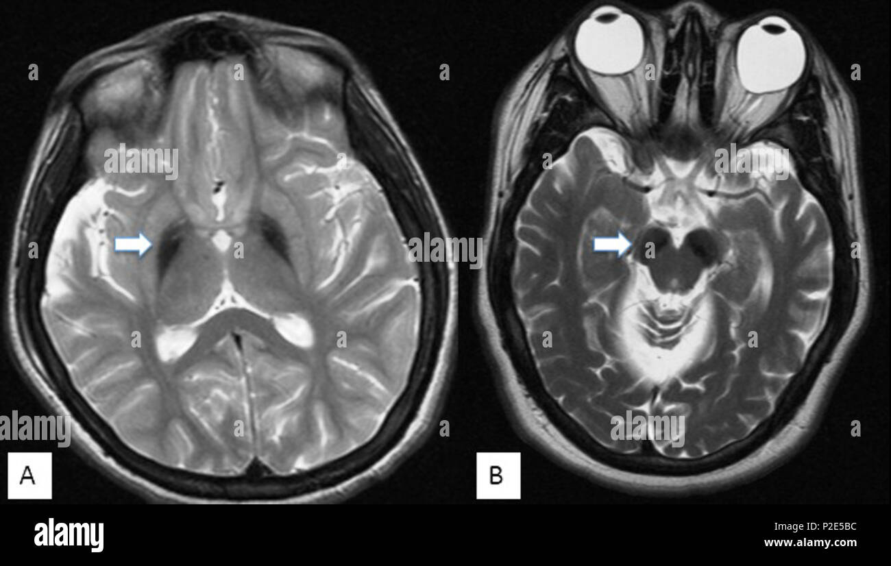 . English: T2-weighted MRI sequences demonstrating globus pallidus hypointensity (A) and hypointensity of the substantia nigra (B)(arrows). In BPAN, the substantia nigra is usually more hypointense relative to the globus pallidus, indicating higher levels of iron. Note: The illustrated findings are not typically present in early childhood, when imaging may be normal or show only hypomyelination, a thin corpus callosum, or cerebral/cerebellar volume loss. Deutsch: T2-gewichtete MRT-Sequenzen, die Globus pallidus-Hypointensität (A) und Hypointensität der Substantia nigra (B) zeigen (Pfeile). Bei Stock Photo