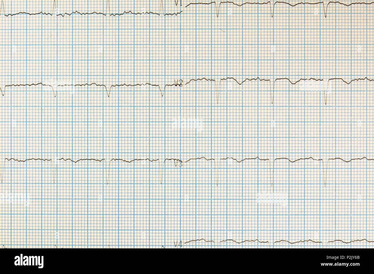 Heart analysis, electrocardiogram graph (ECG Stock Photo - Alamy