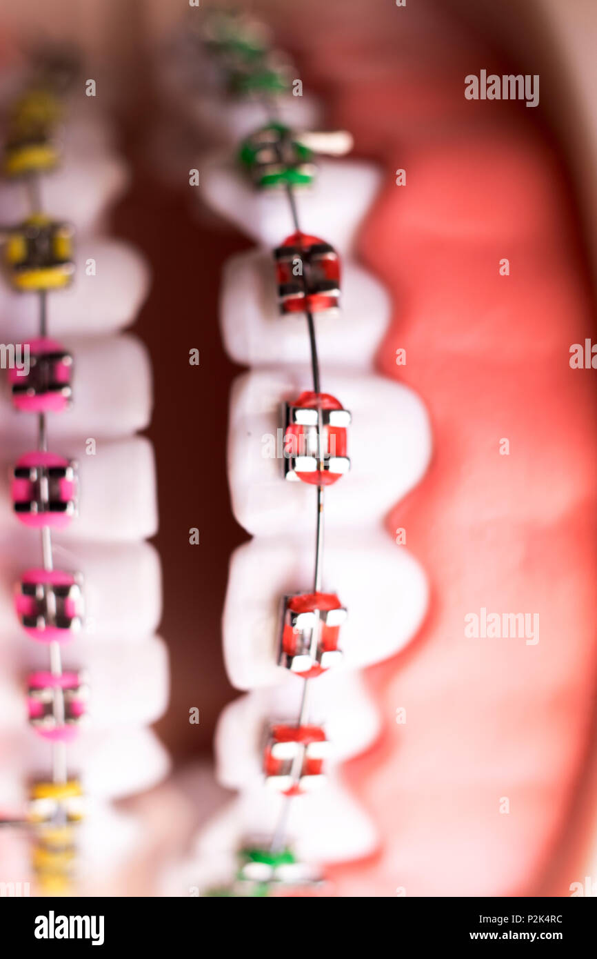 Dental metal braces teeth retainer aligners teaching orthodontics model ...