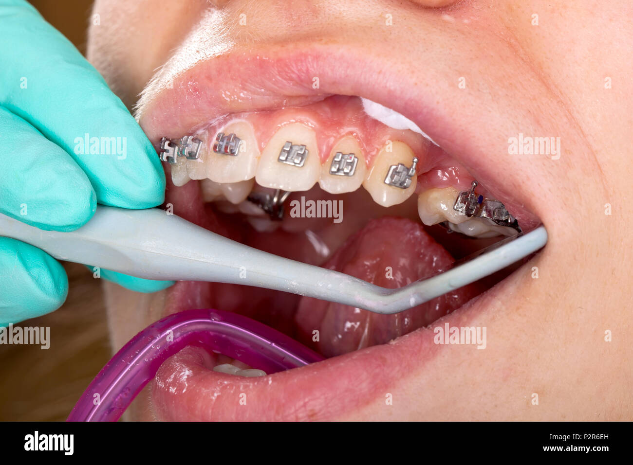 Close up picture of young female's mouth. Dental braces treatment