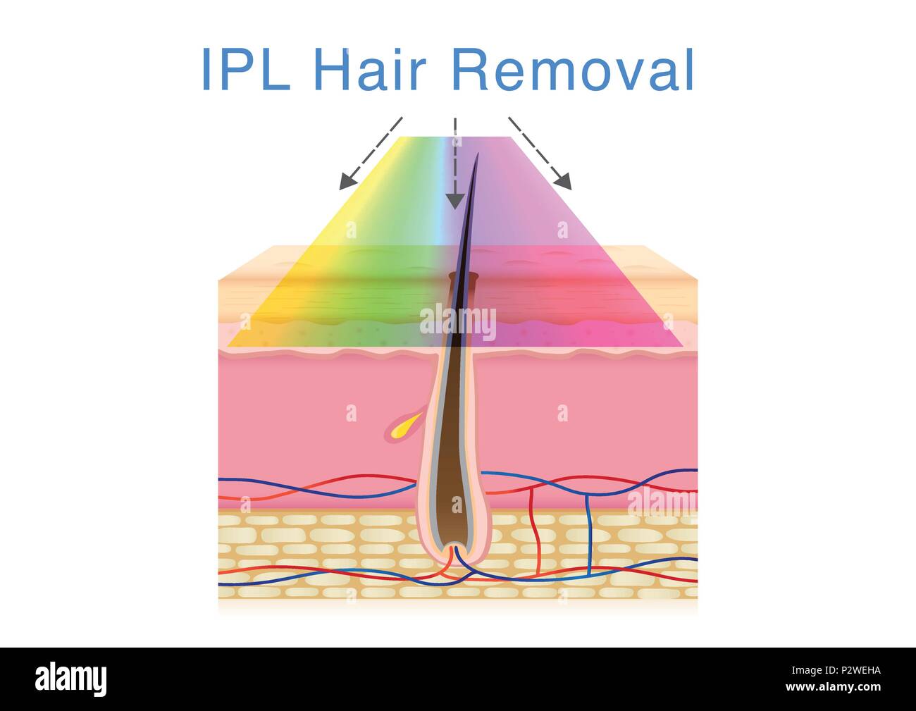 Using IPL light for hair removal on human skin. Stock Vector