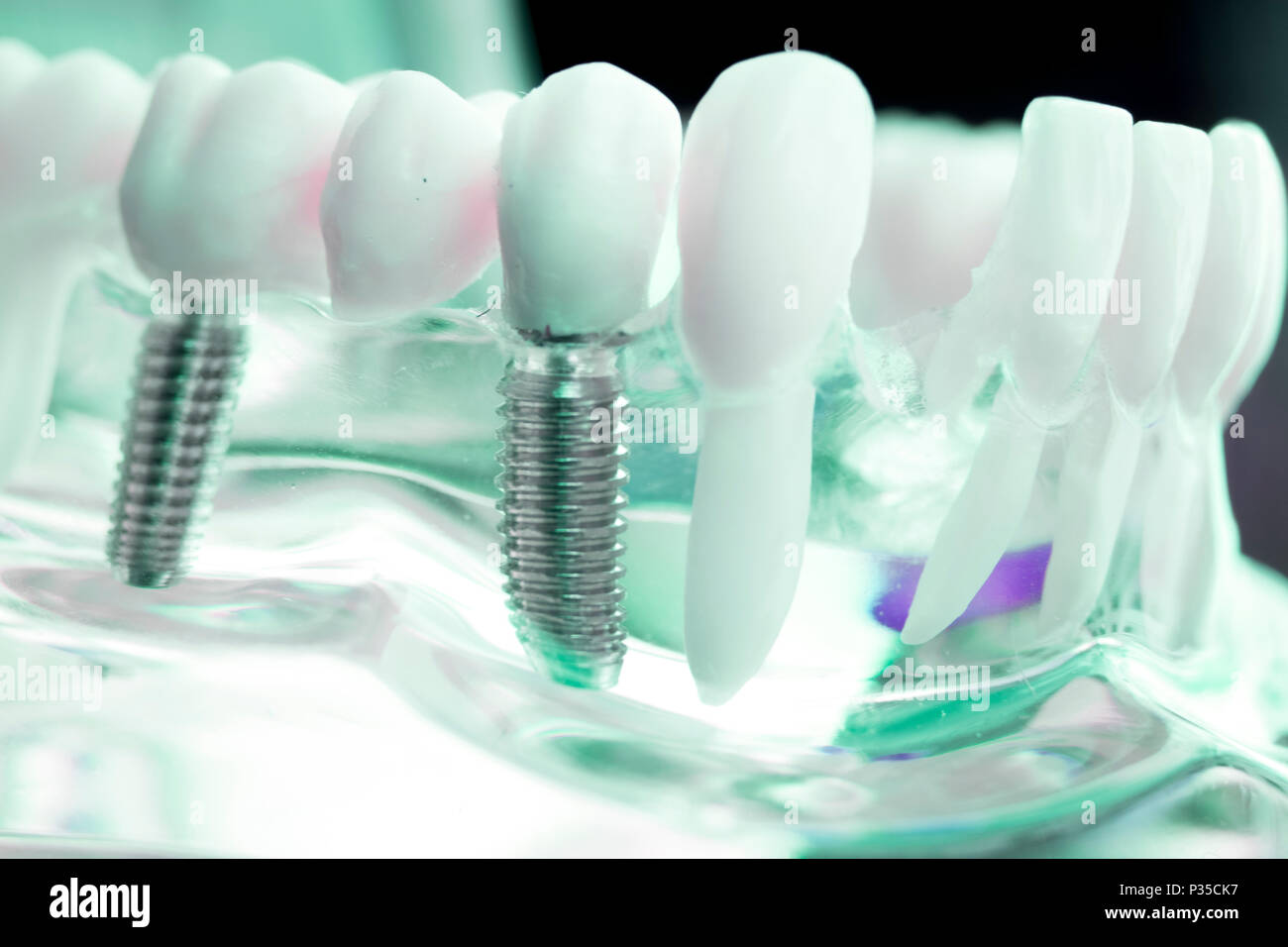 Dentist dental teeth teaching model showing titanium metal tooth