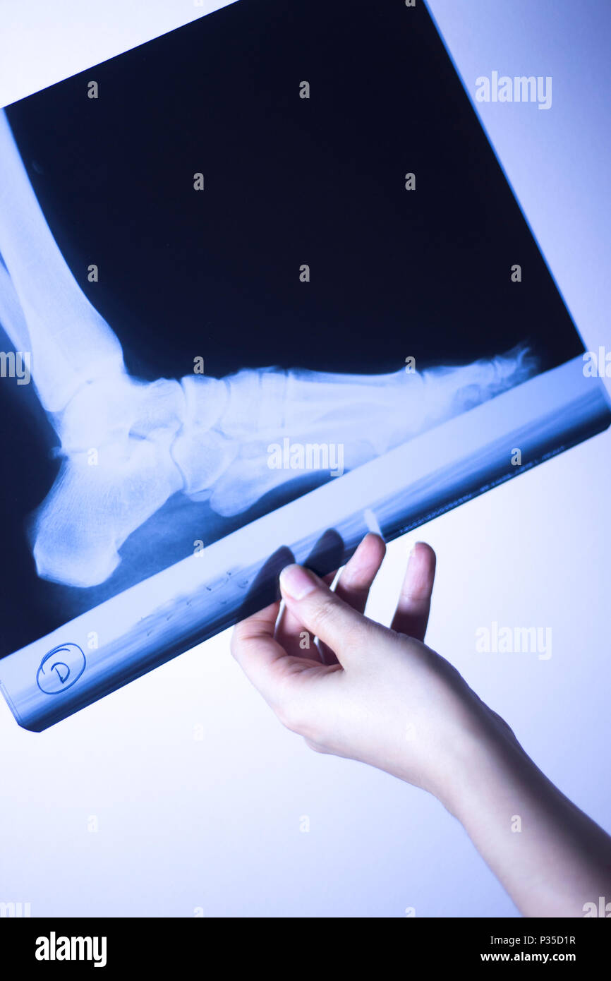 Medical hospital xray feet traumatology scan Stock Photo Alamy