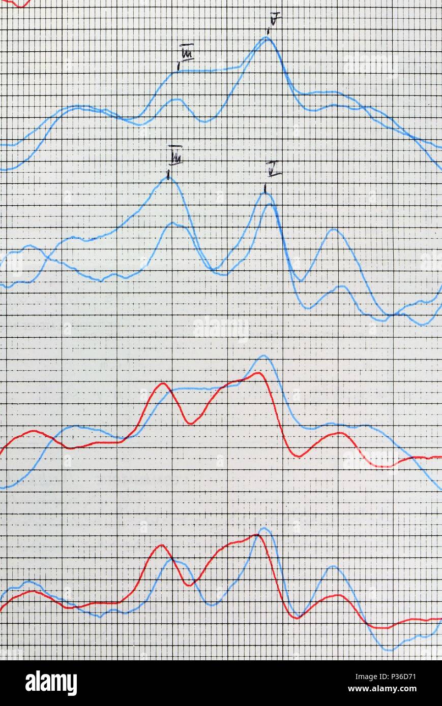 Hearing examination report. Tinnitus problem analysis. Stock Photo