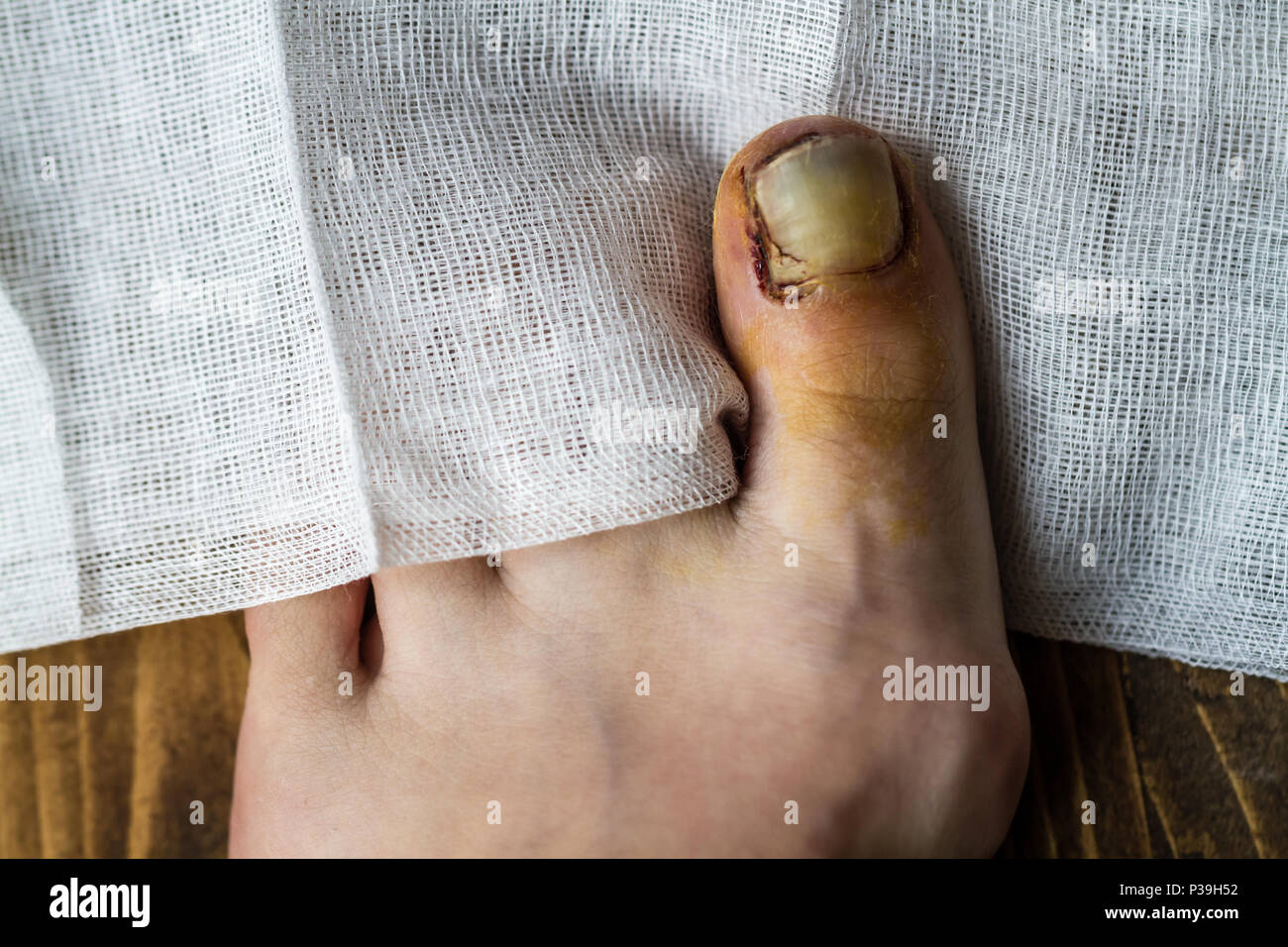 Newly broken nail about to lift away from the finger by traumatic accident  Stock Photo - Alamy