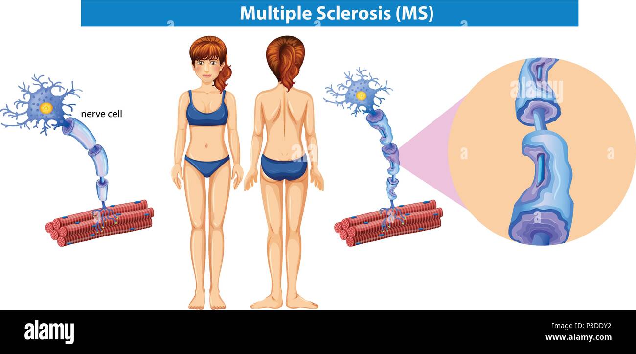 A Human Anatomy of Multiple Sclerosis illustration Stock Vector