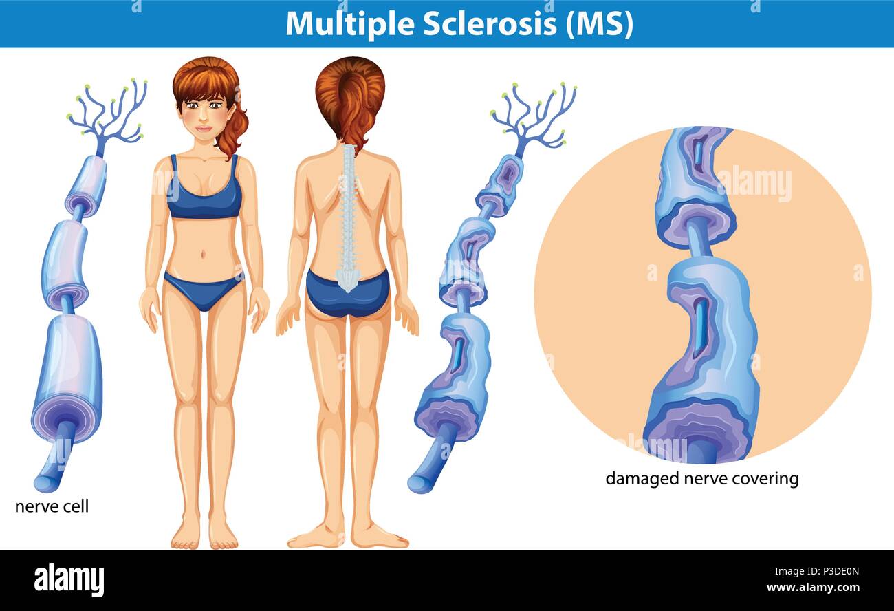 A Human Anatomy of Multiple Sclerosis illustration Stock Vector