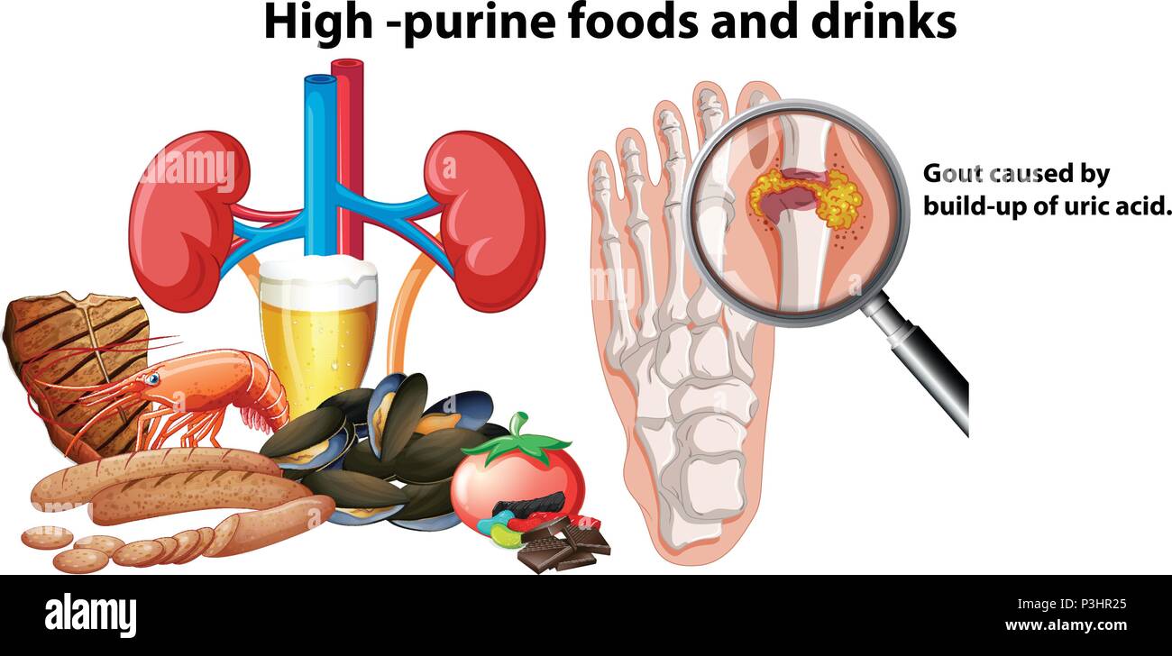 HighPurine Foods and Drinks illustration Stock Vector Image & Art Alamy