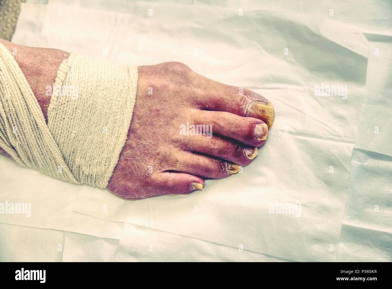 Pedicure stages. Podology, cutting skins. Professional pedicure in the