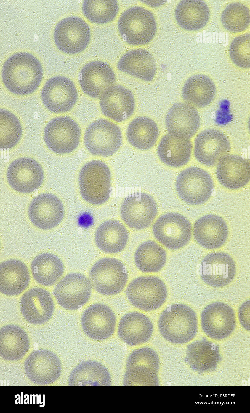 red blood cells infected with the malaria parasite. Plasmodium vivax. Stock Photo