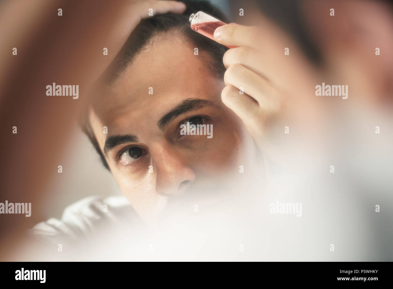 Young Man Applying Lotion For Alopecia And Hair Loss Treatment Stock Photo