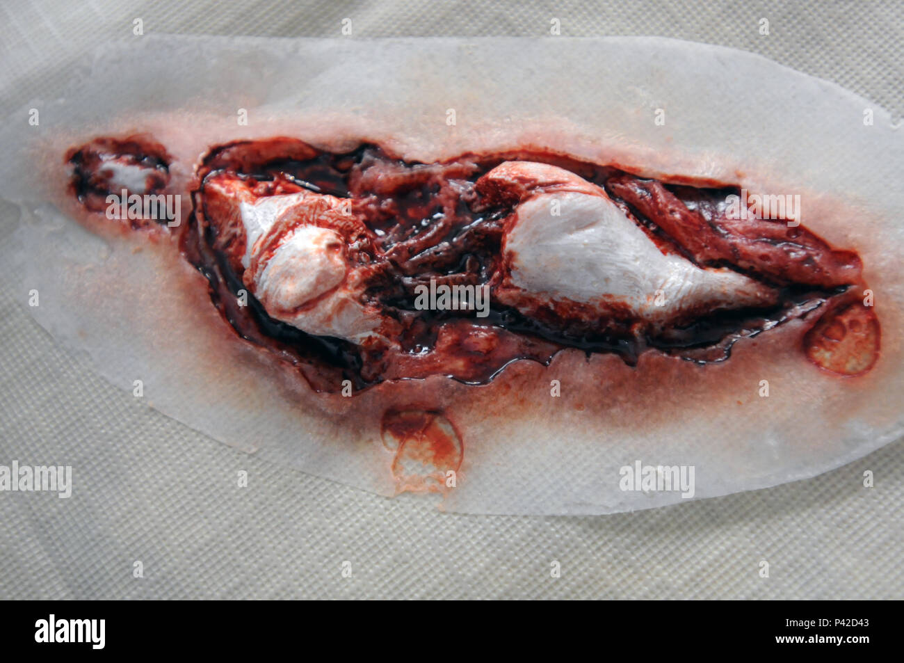 Compound Fracture Stock Photos Compound Fracture Stock Images