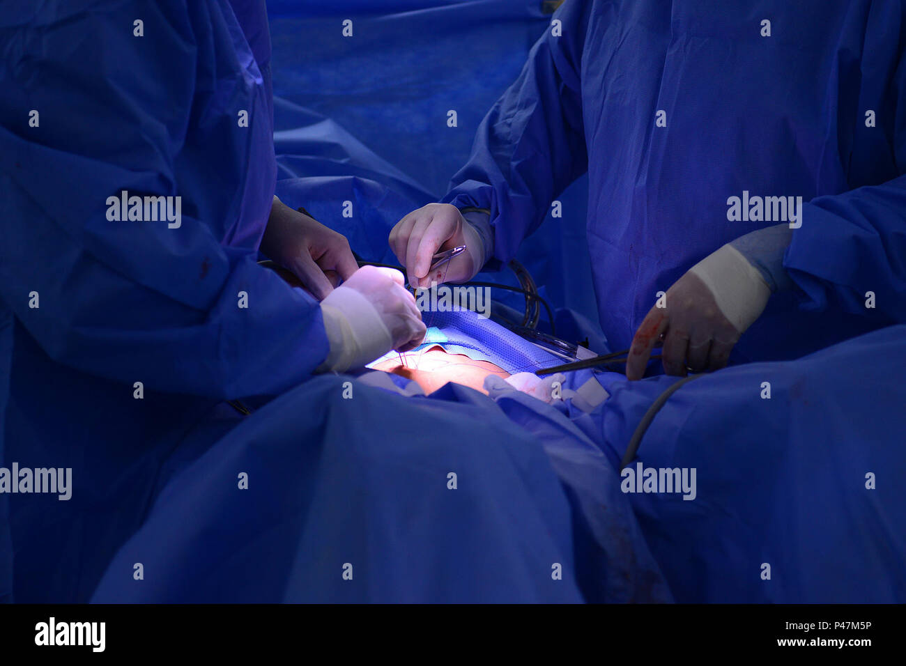 Laparoscopic hysterectomy hi-res stock photography and images - Alamy
