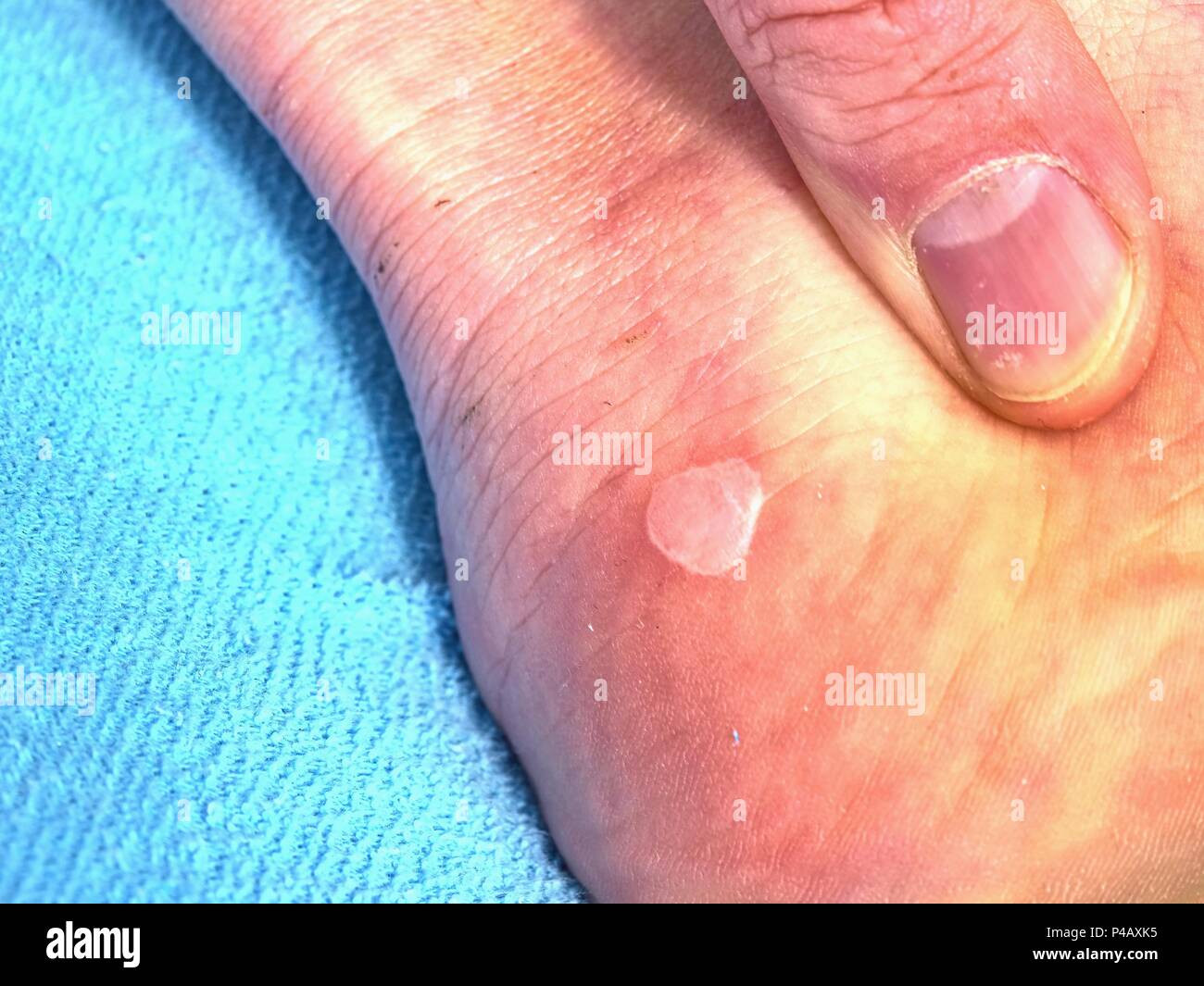 Callus Heel High Resolution Stock Photography and Images Alamy