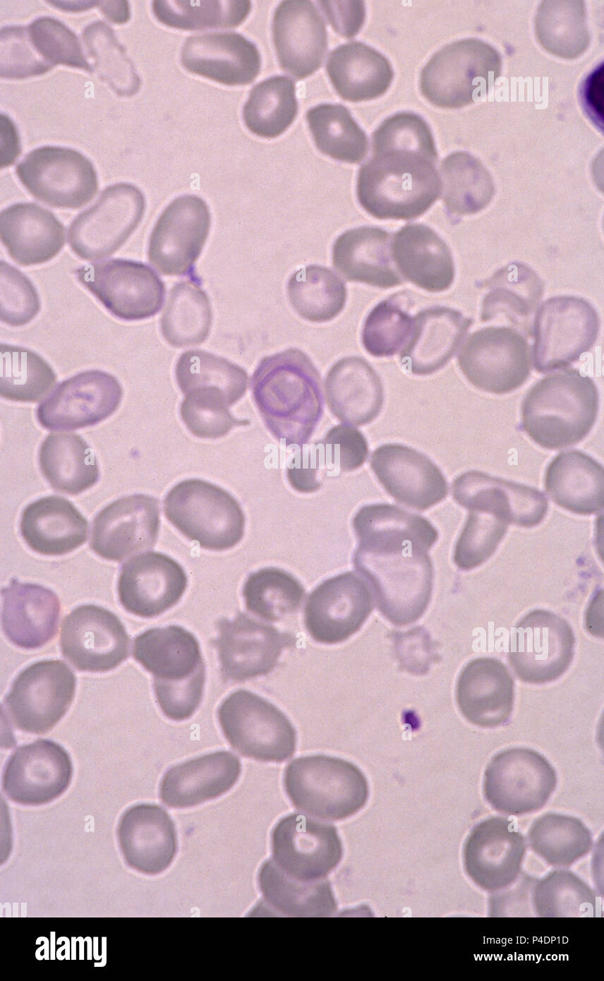 Red blood cells with anaemia Stock Photo