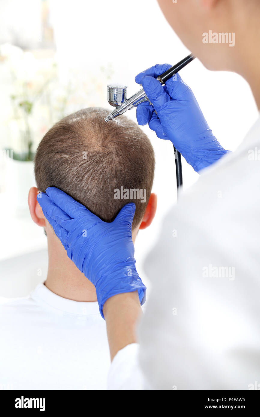 Oxygen mesotherapy of the scalp. Treatment against hair loss. Oxygen mesotherapy The head of a man with thinning hair during a care treatment Stock Photo