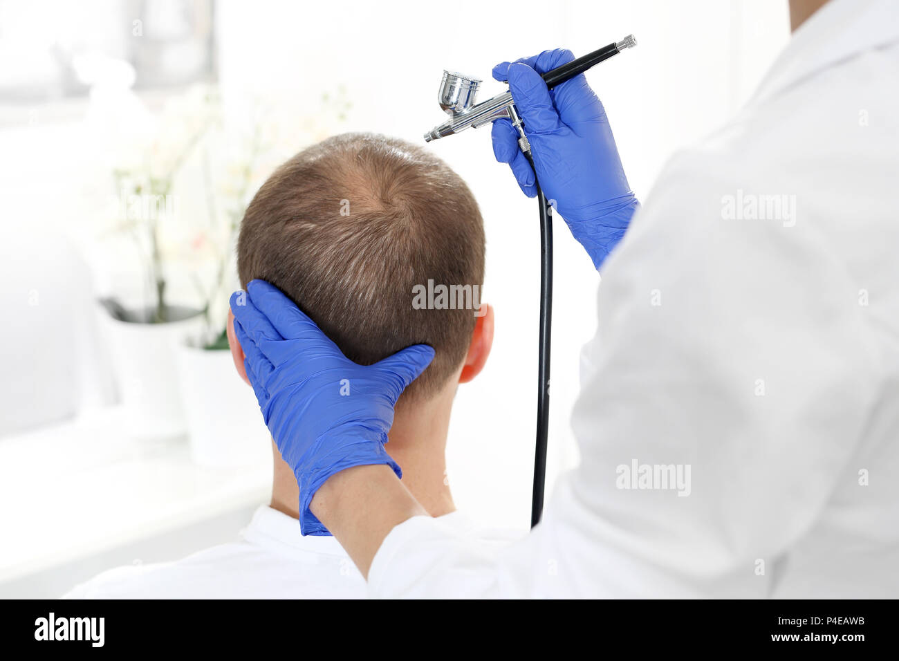 Oxygen mesotherapy of the scalp. Treatment against hair loss. Oxygen mesotherapy The head of a man with thinning hair during a care treatment Stock Photo