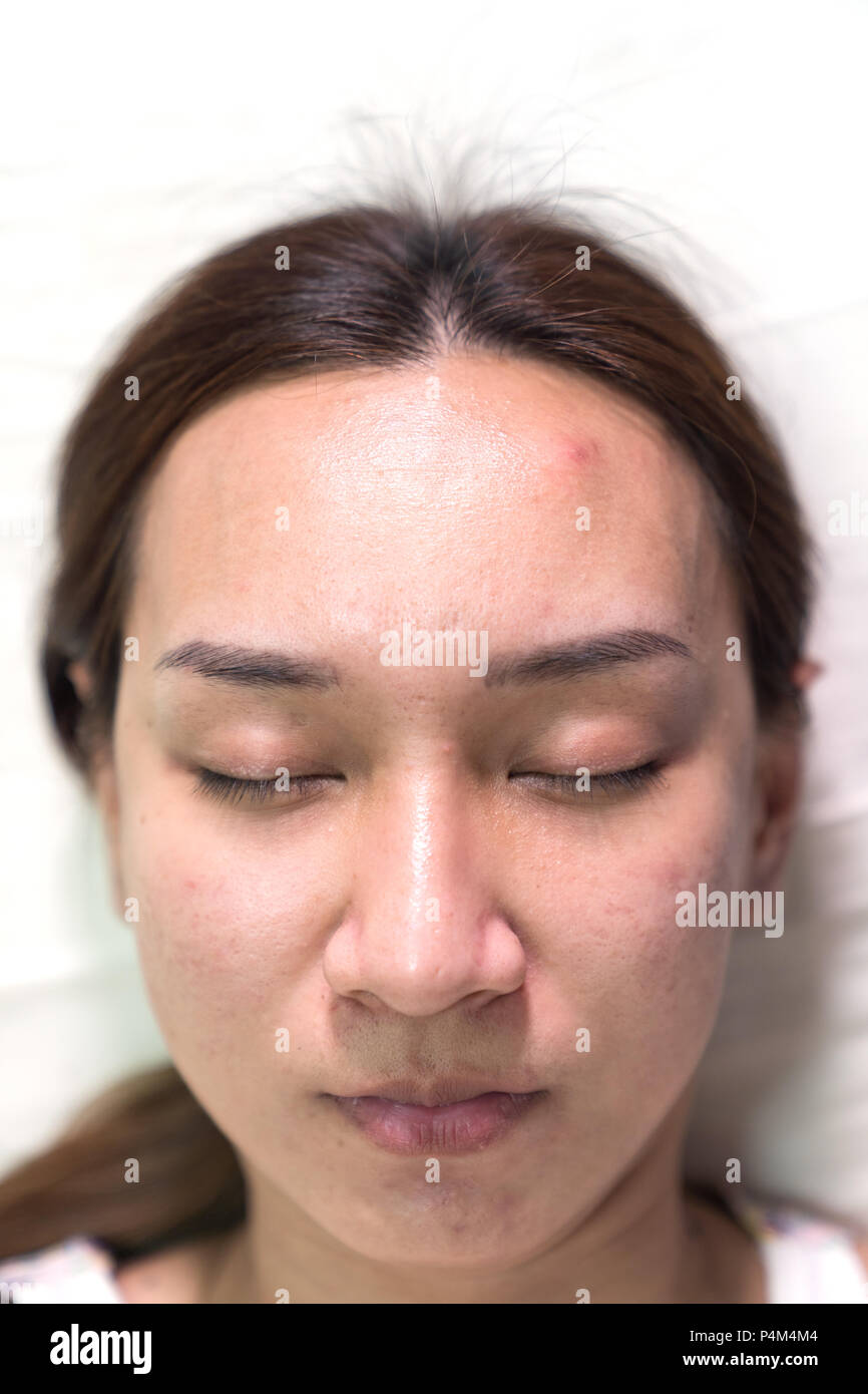 Close up Asian beautiful woman is acne skin problem on forehead, healthy skin care female concept background. Stock Photo