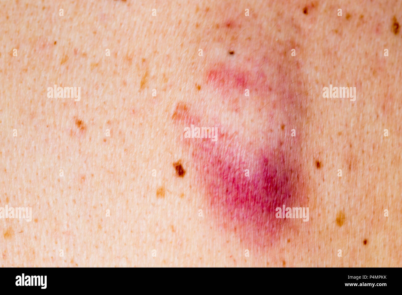 Detail of the bare skin on man in the back, Disorders of body with moles on skin growths include warts lot of wart, mole, birthmark, wart, gnarl, wart Stock Photo