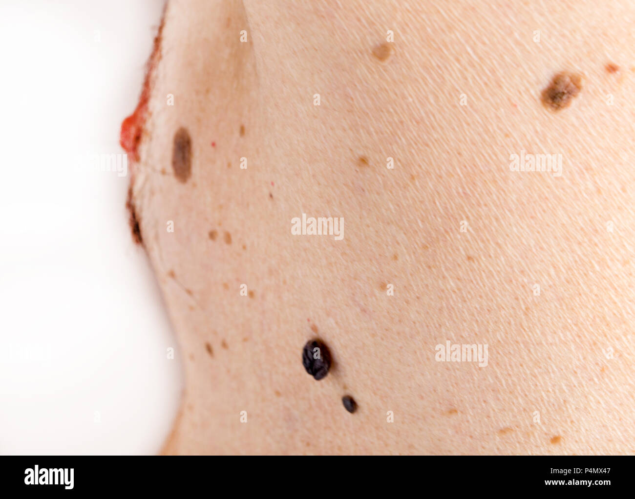 Warts And Moles On Skin