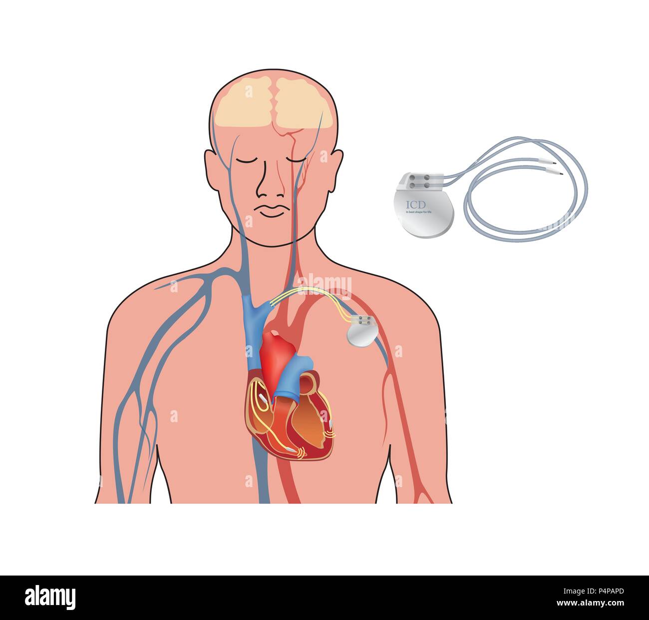 Heart pacemaker. Human heart anatomy cross section with working