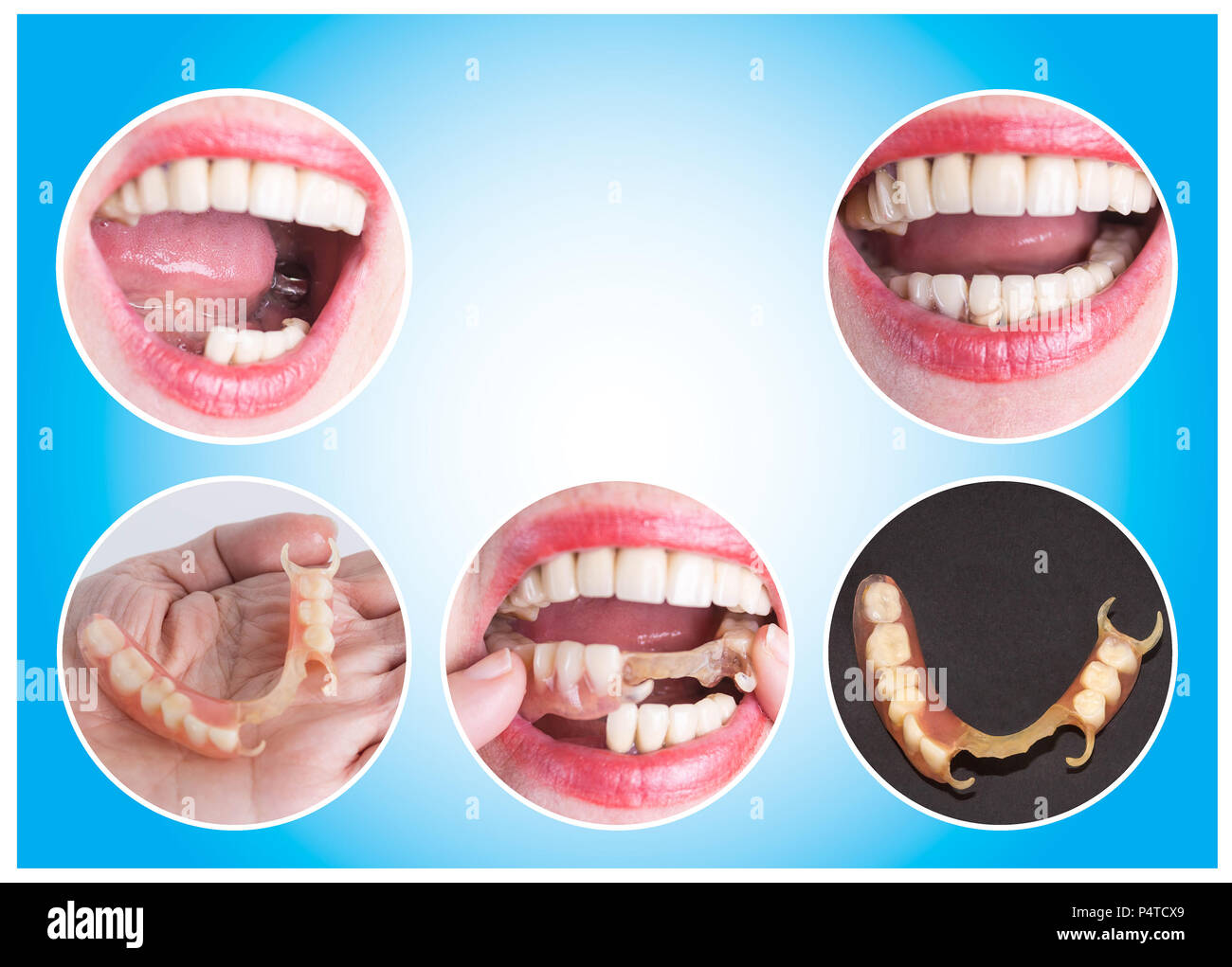 Clasp prosthesis for upper jaw Clasp prosthesis for upper jaw