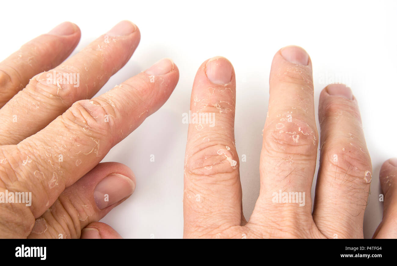 Irritated Skin Peeling On Fingertips Due Stock Photo 1306614661 |  Shutterstock