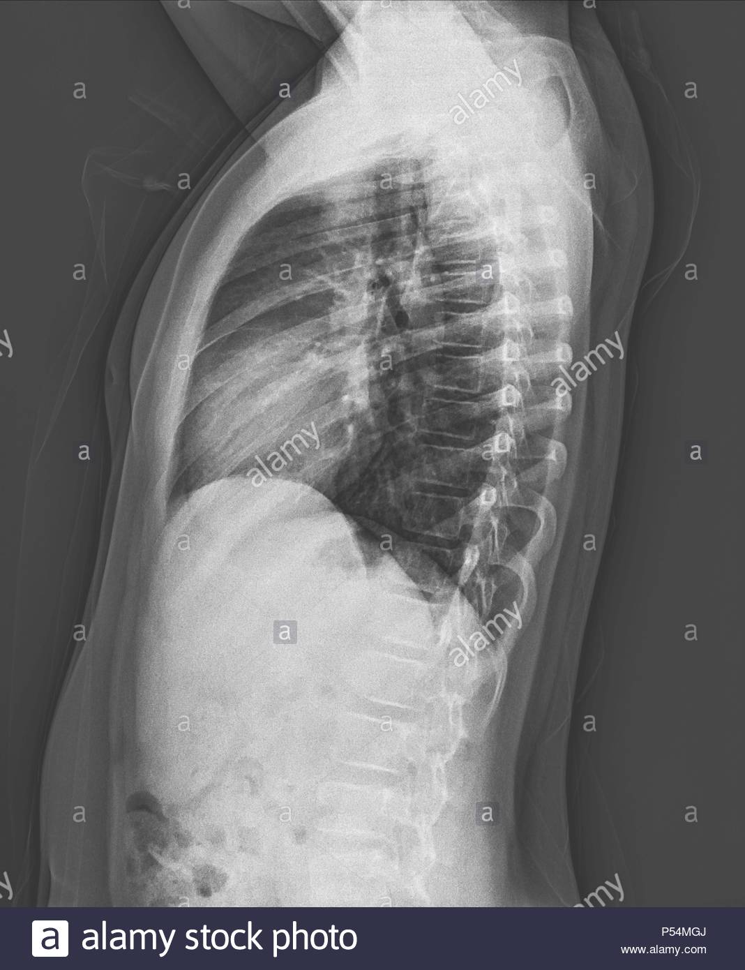Chest X Ray Of Child Stock Photos & Chest X Ray Of Child Stock Images Alamy