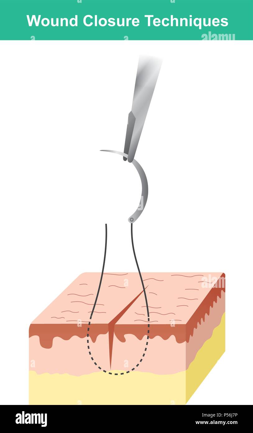 Wound is a type of injury which happens relatively quickly in which skin is torn, cut, or punctured or where blunt force trauma causes a contusion. Stock Vector