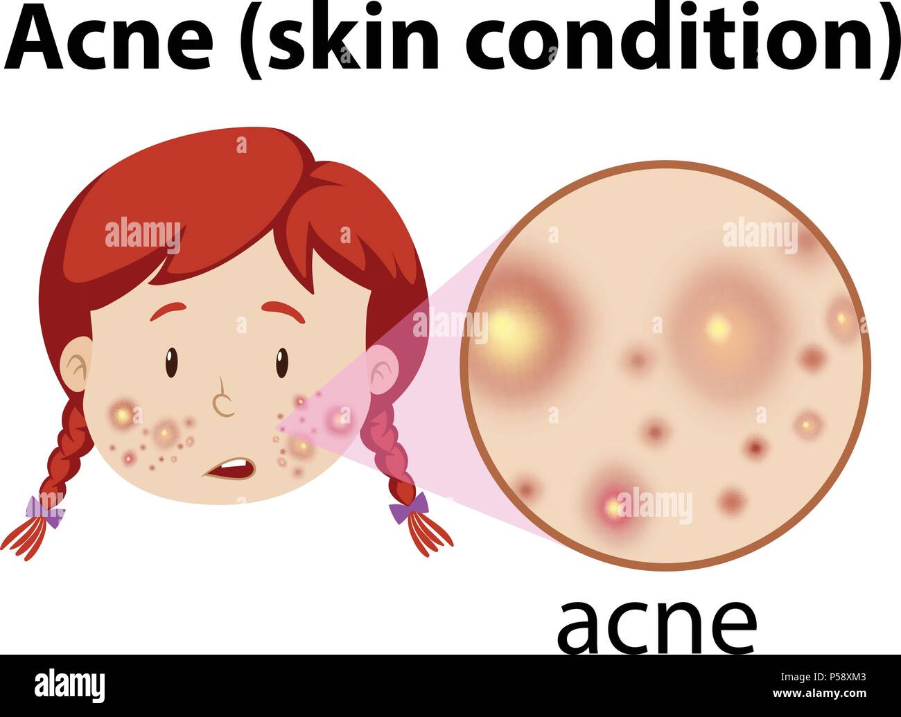 Acne drawing hi-res stock photography and images - Alamy