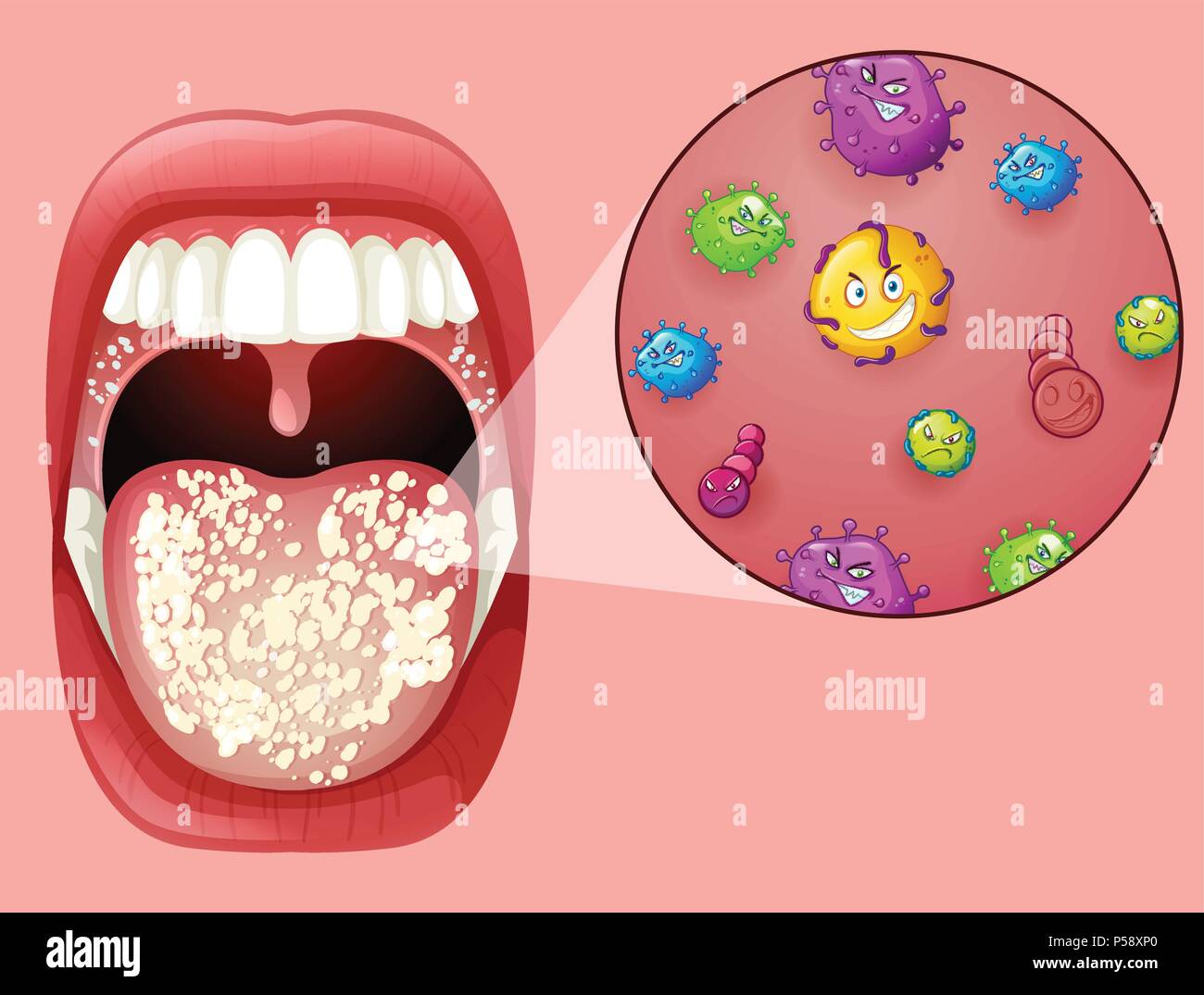 Human Mouth with Oral Thrush illustration Stock Vector