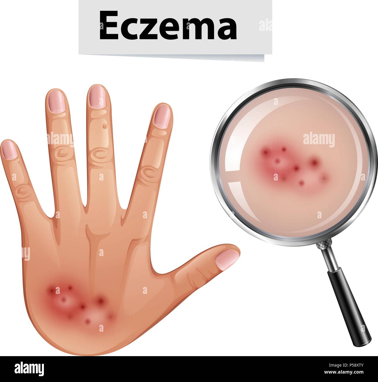 A Human Hand with Eczema illustration Stock Vector