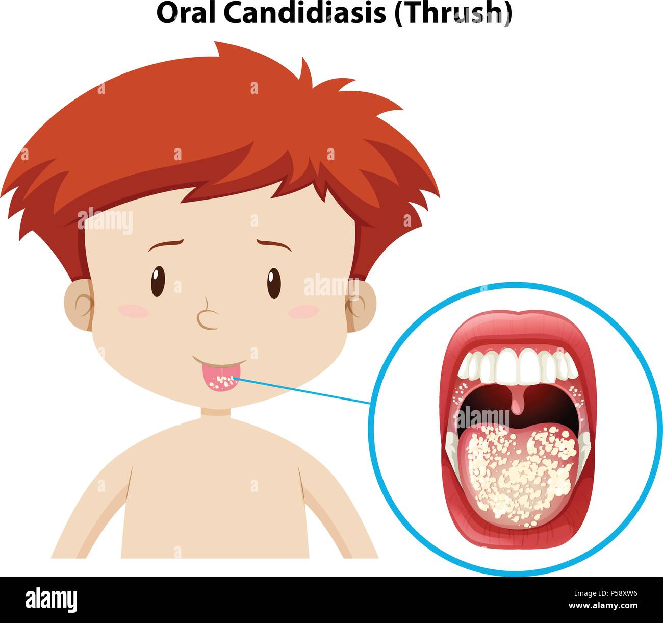A Young Boy with Oral Candidiasis illustration Stock Vector