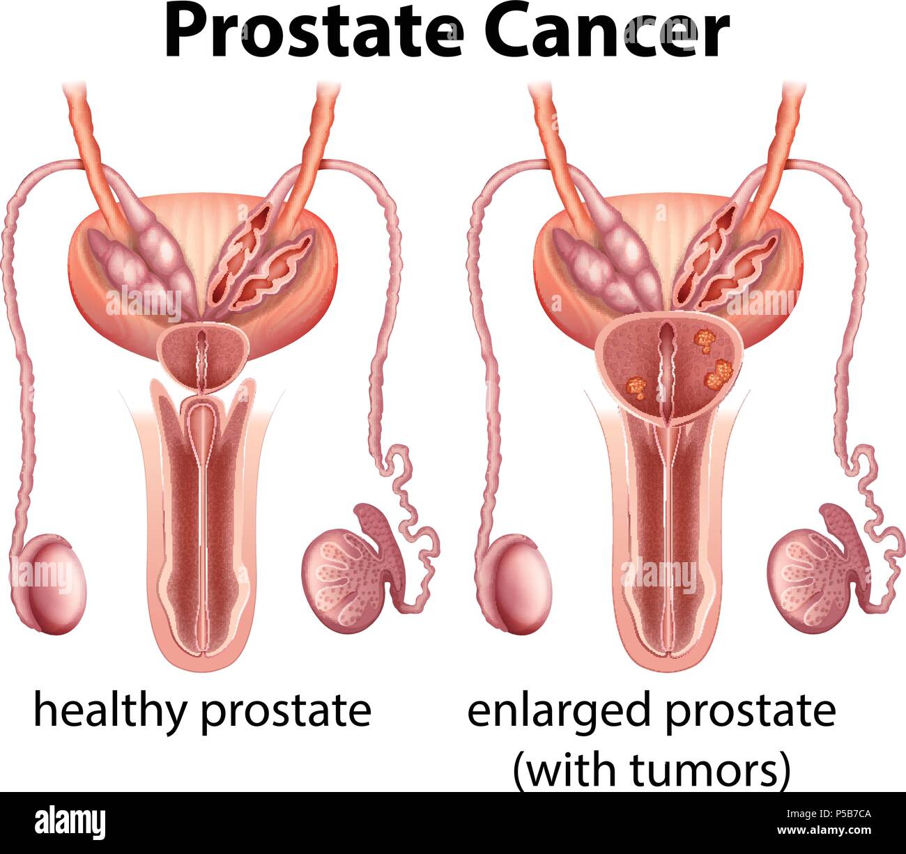 Comparison of Healthy and Cancer Prostate illustration Stock Vector