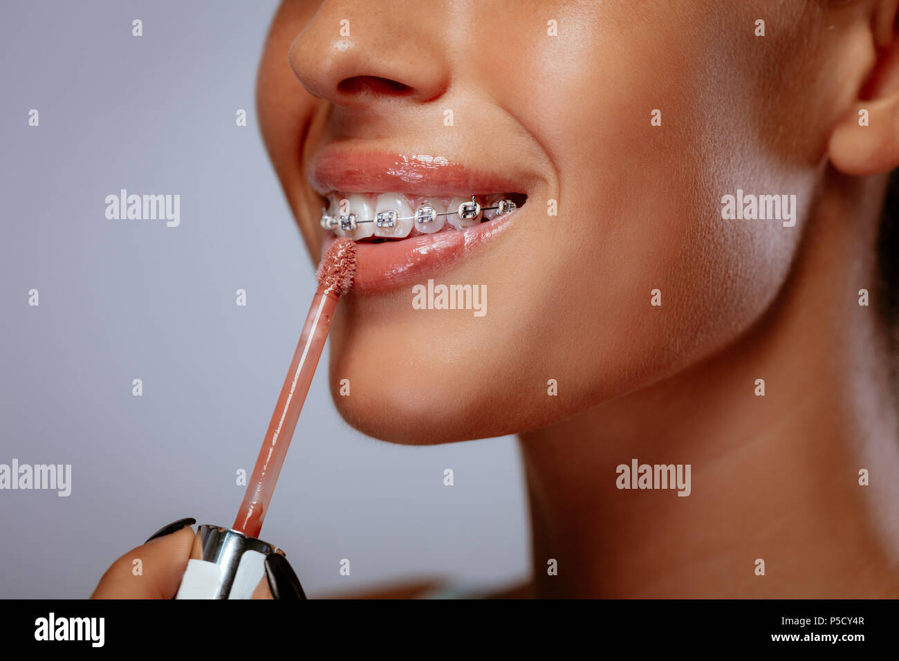 Smiling young woman with braces applying lip gloss on her lips Stock