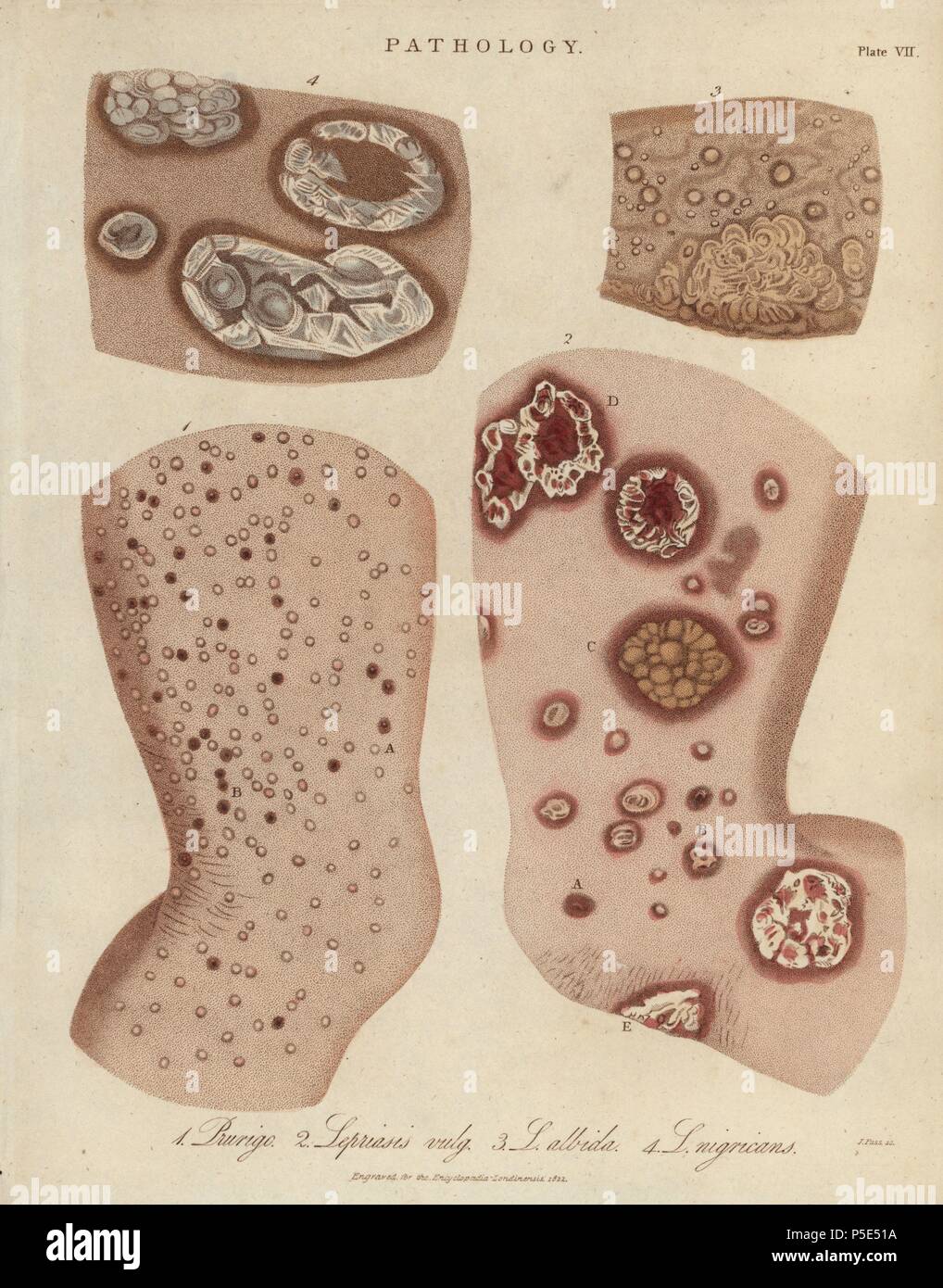 Skin diseases: Prurigo nodularis and Psoriasis varieties. (Lepriasis is an obsolete term for psoriasis and leprosy.) Handcoloured copperplate stipple engraving by John Pass from John Wilkes' 'Encyclopedia Londinensis,' J. Adlard, London, 1822. Stock Photo