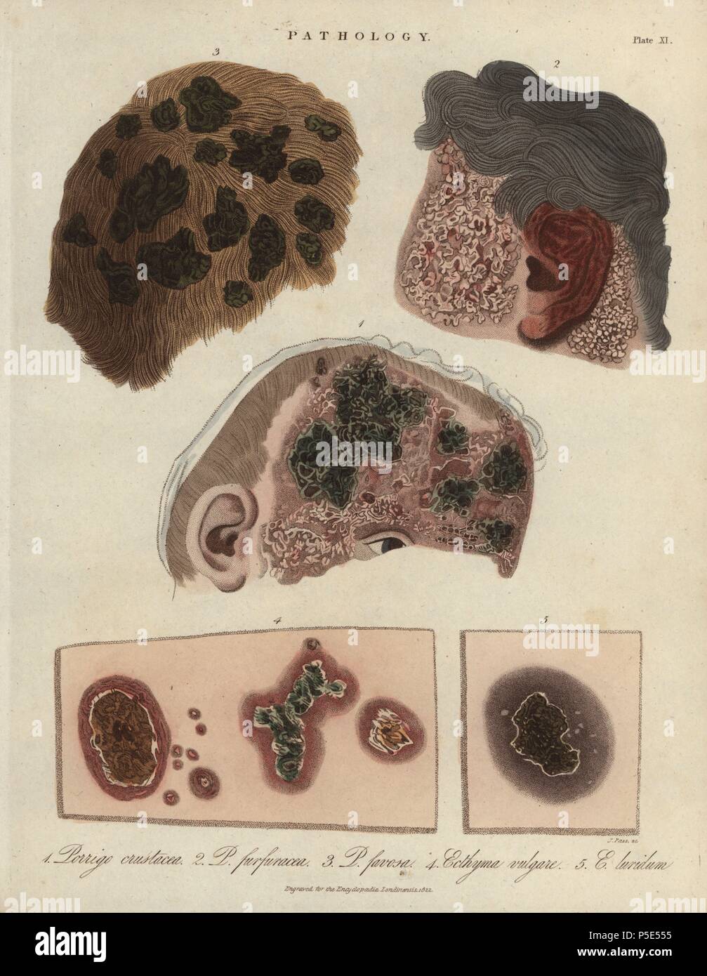 Scalp diseases Porrigo crustacea and P. furfuracea, and skin diseases Ecthyma vulgaris and E. luridum, ulcerative pyoderma of the skin caused by bacteria such as Streptococcus pyogenes. Handcoloured copperplate stipple engraving by John Pass from John Wilkes' 'Encyclopedia Londinensis,' J. Adlard, London, 1822. Stock Photo