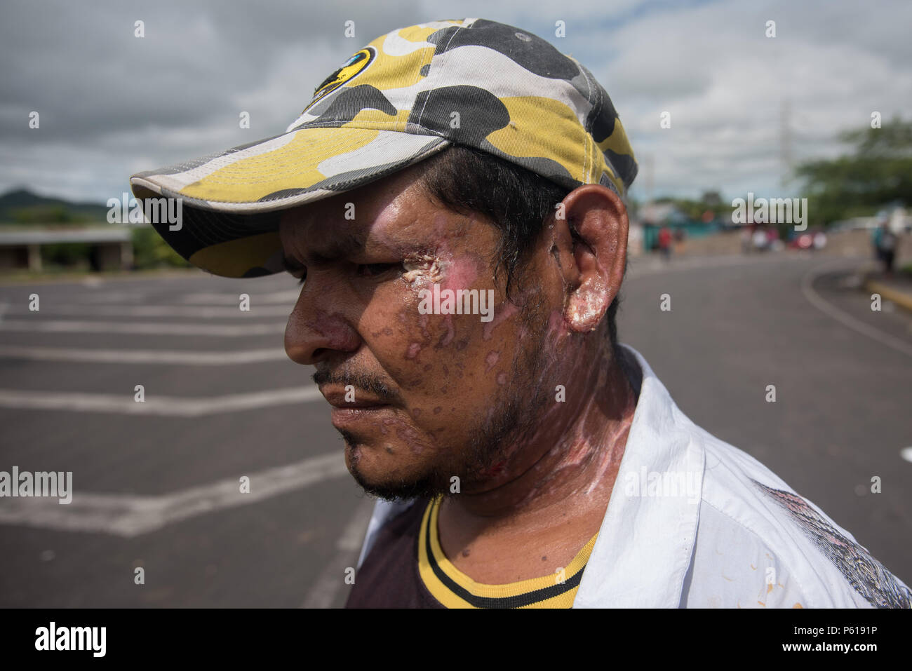 27 June 2018, Nicaragua, Chontales: A man shows burnings caused during the  clashes with a barricade. Citizens and farm workers blocked a country road  from Managua to Chontales. The blockades are part