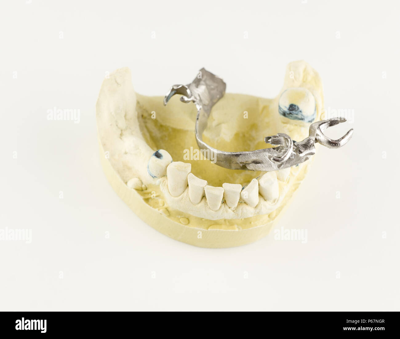 steel base of the clasp prosthesis on the gypsum model Stock Photo - Alamy