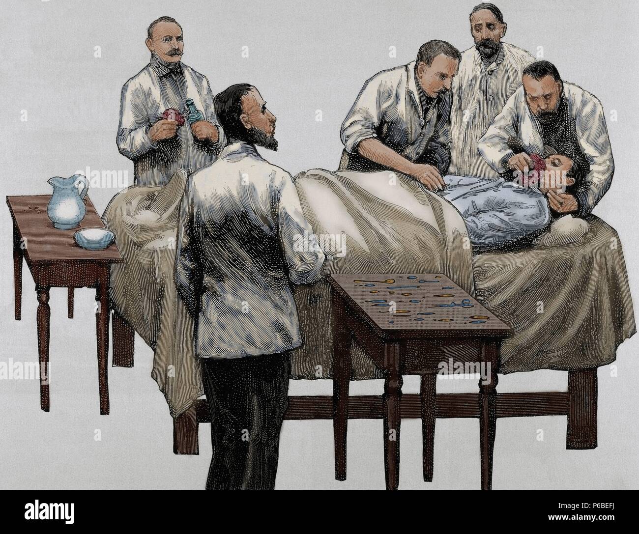 History of medicine. Chloroform anesthesia. Engraving, 19th century. Colored. Stock Photo