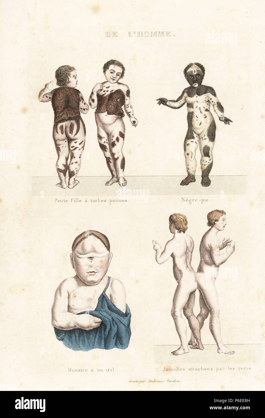 Young girl with hirsutism, boy with vitiligo, child with one eye, conjoined twins. Handcoloured engraving on steel by Ambroise Tardieu from Richard's 'New Edition of the Complete Works of Buffon,' Pourrat Freres, Paris, 1837. Stock Photo