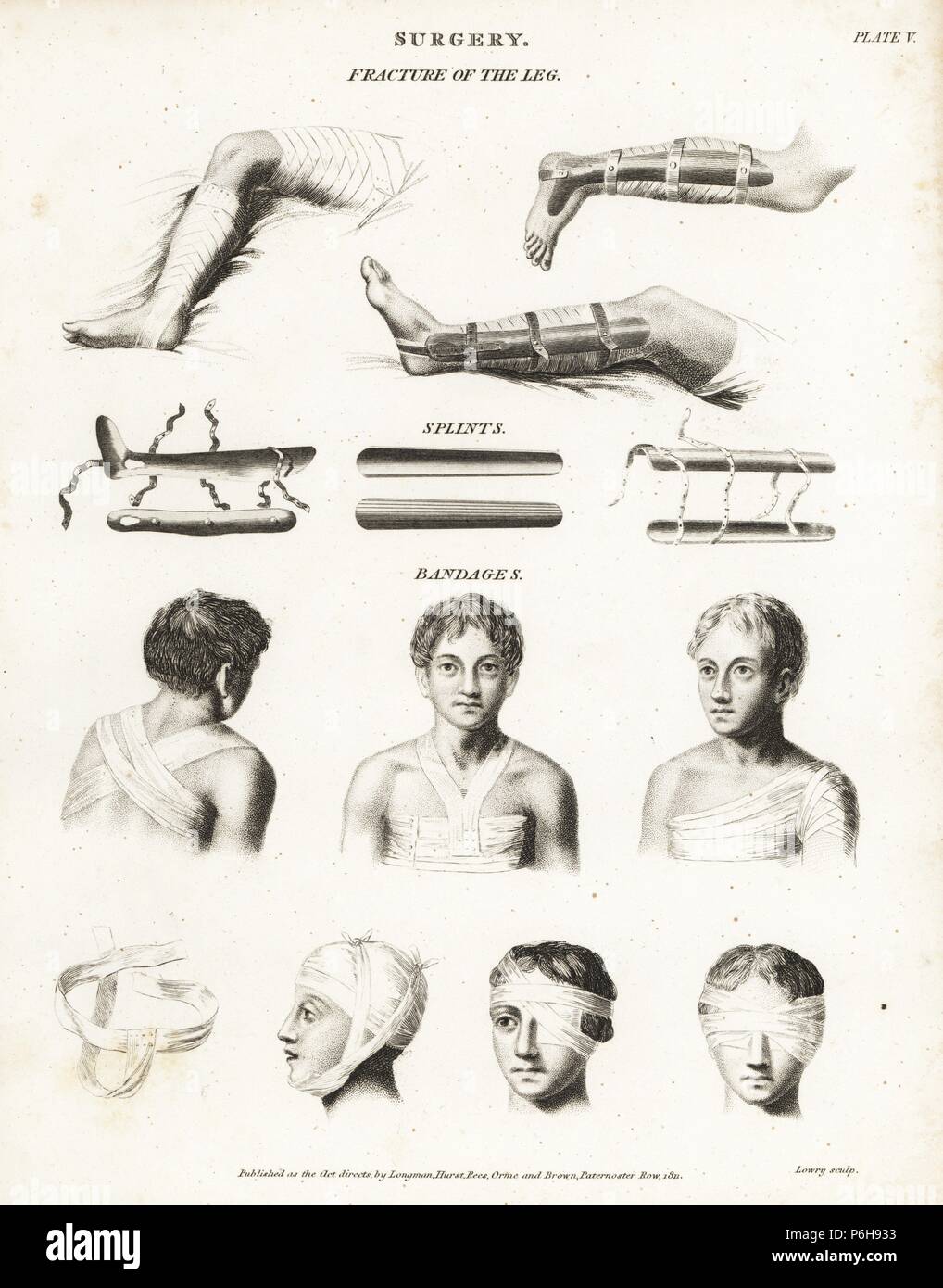 Surgical procedures from the 19th century: splints and bandages for a fracture of the leg. Copperplate engraving by Wilson Lowry from Abraham Rees' 'Cyclopedia or Universal Dictionary,' London, 1810. Stock Photo