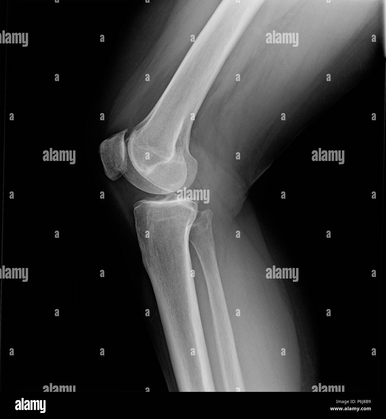 X-ray of knees of mature female suffering from minor osteoarthritis and bone spurs. Stock Photo
