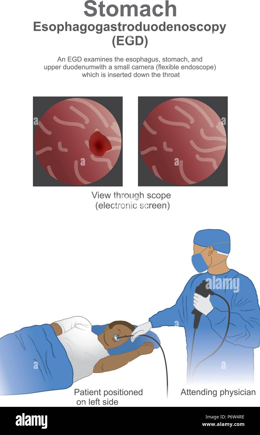 Esophagogastroduodenoscopy EGD is a test to examine the lining of the esophagus, stomach, and first part of the small intestine. Stock Vector