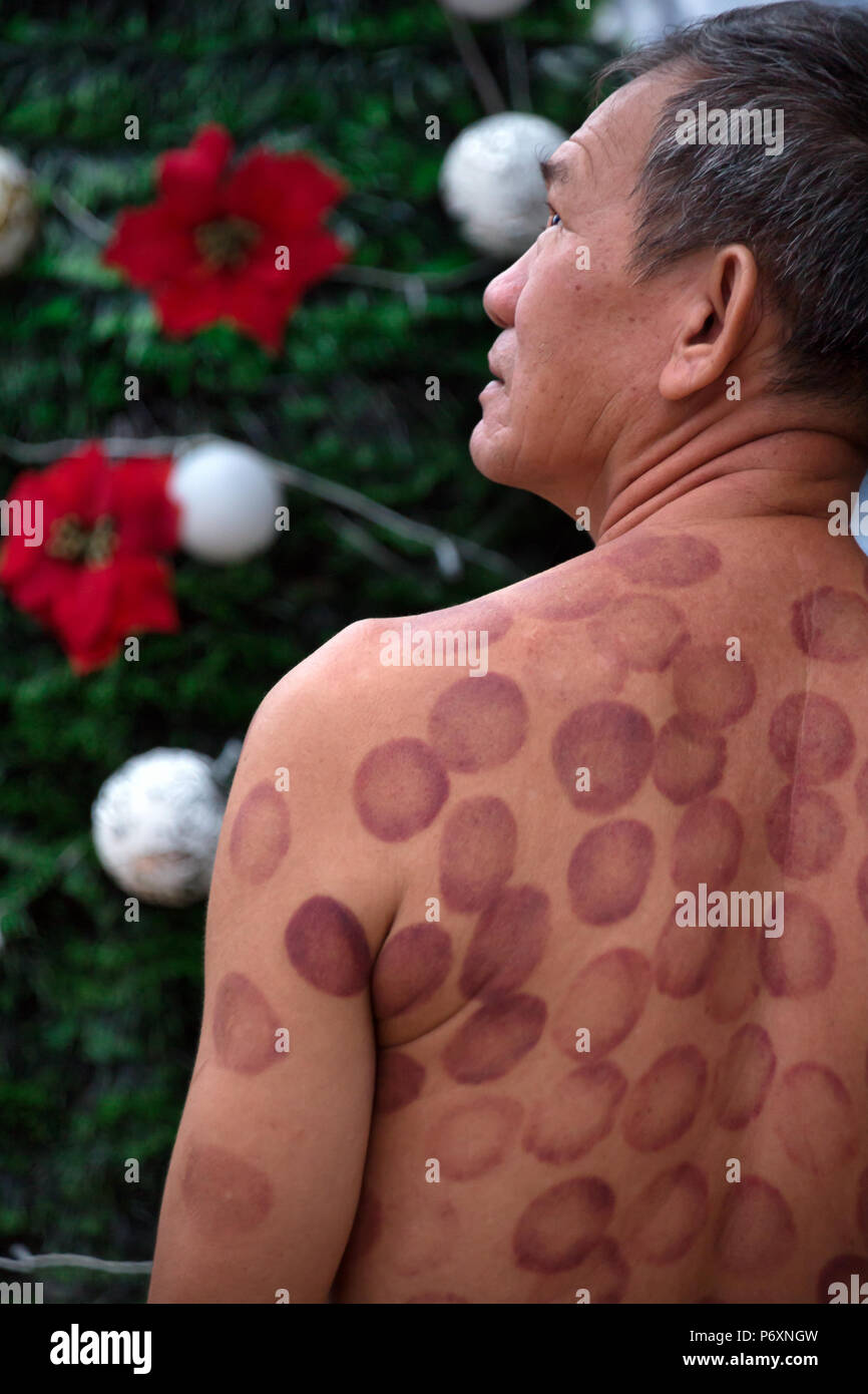 Cupping therapy, Can Tho , Vietnam Stock Photo