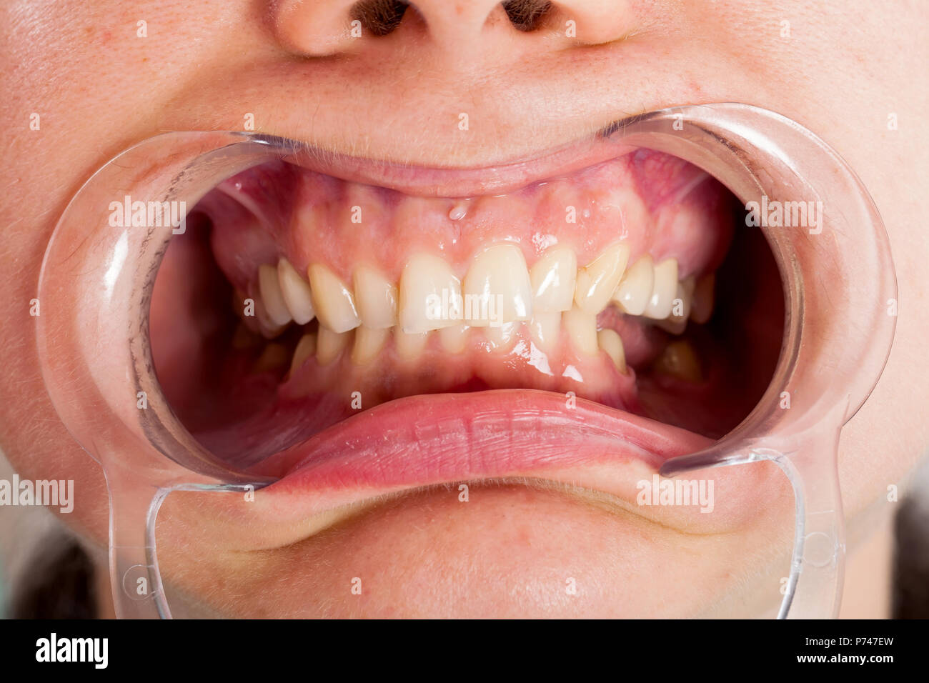Close up picture of cheek retractor in patient's mouth. Dental