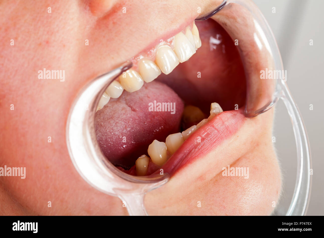 Close up picture of cheek retractor in patient's mouth. Dental